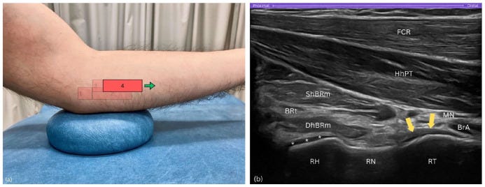 Tendon distal biceps 6 2 Tempo Formacion Ecografia.jpg